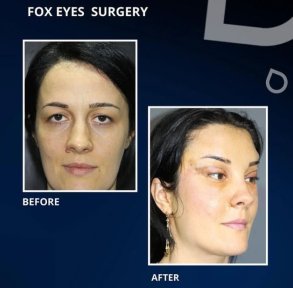 Premium Blepharoplasty (Eyelid correction) with All Included - photo 2