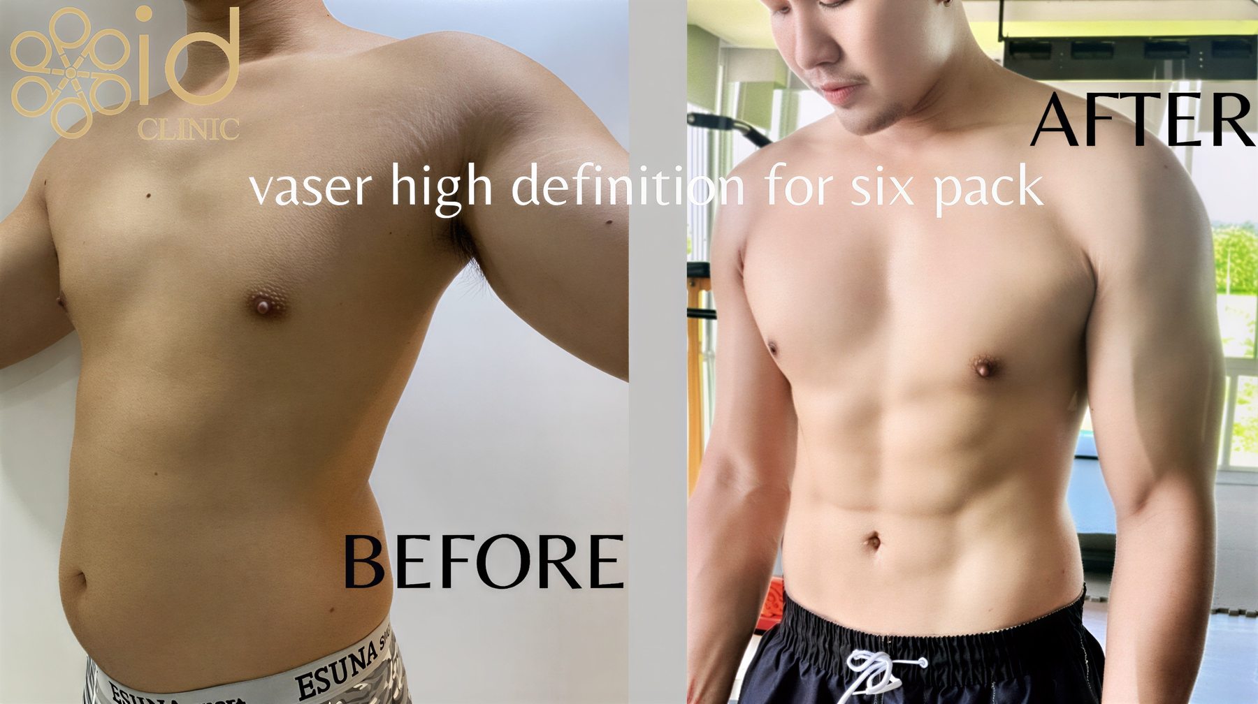 Antes y después de liposucción Vaser para abdominales en ID Clinic Bangkok, resultado definido