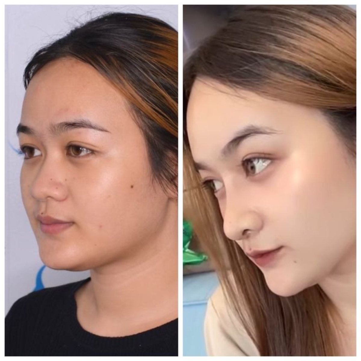 قبل وبعد عملية تجميل الأنف في عيادة Janasia، نتائج طبيعية لتعديل الأنف