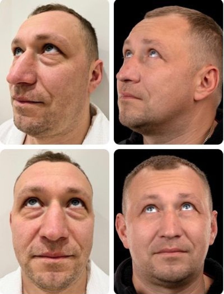Résultats avant/après lifting du visage chez Yurchenko Plastic Surgery Team, rajeunissement visible