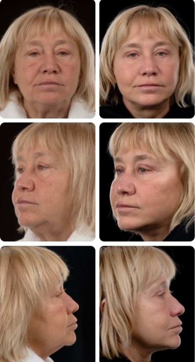 Resultados de lifting facial antes y después en Yurchenko Plastic Surgery Team, rejuvenecimiento