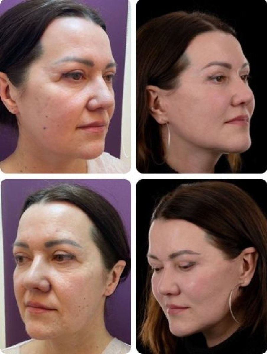 Facelift before and after results at Yurchenko Plastic Surgery Team, visible facial rejuvenation