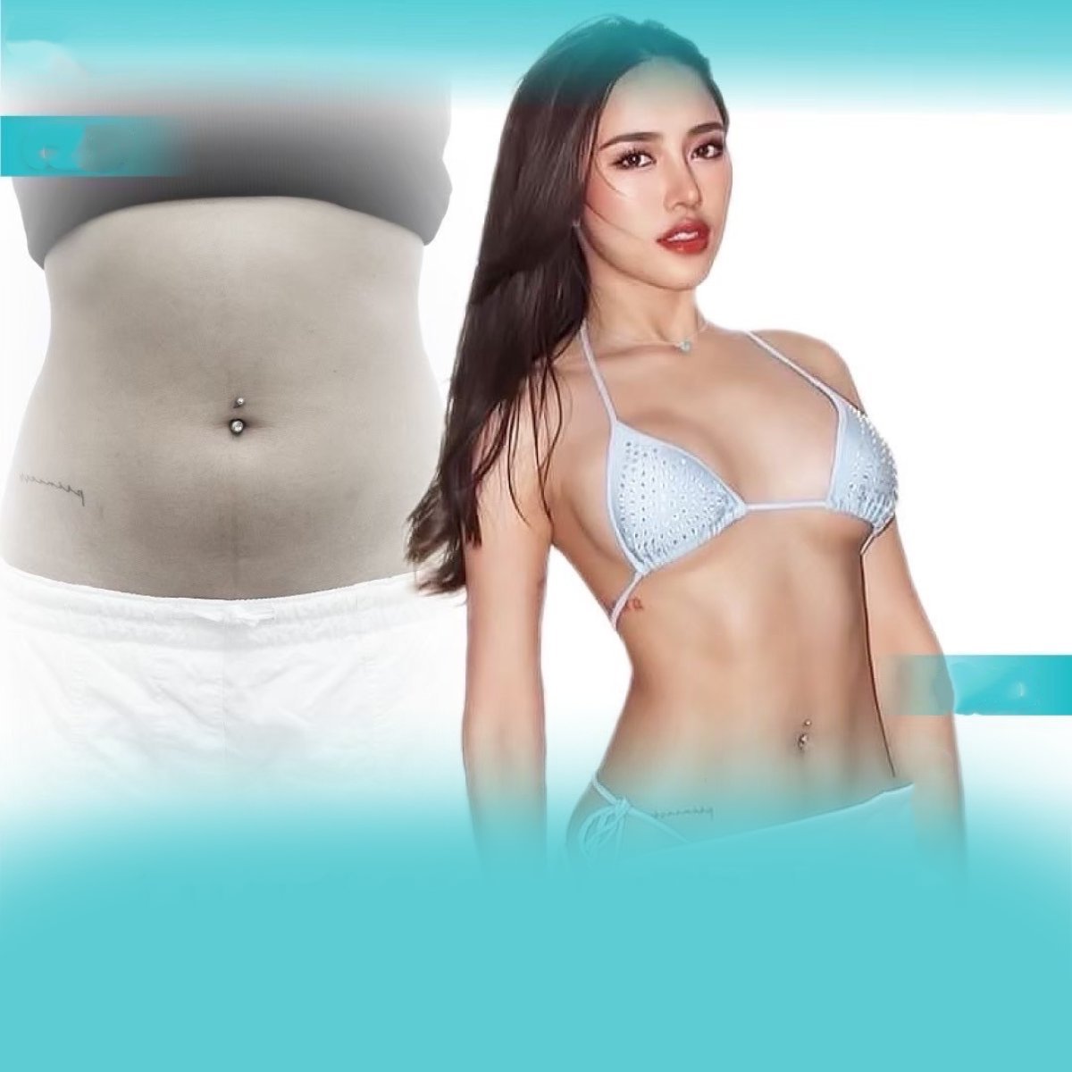 Resultados de abdominoplastia y liposucción antes y después en Wansiri Hospital, cintura más delgada