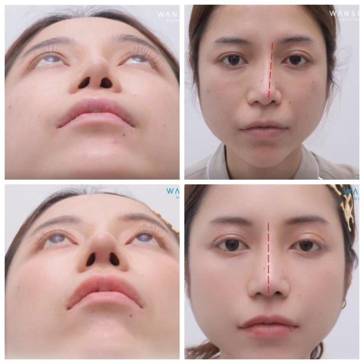 Before and after septoplasty results at Wansiri Hospital, improved nasal alignment visible