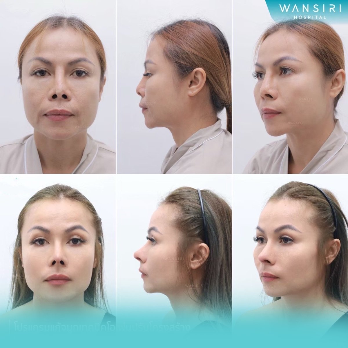 Результаты септопластики до и после в Wansiri Hospital, улучшена форма и дыхание носа