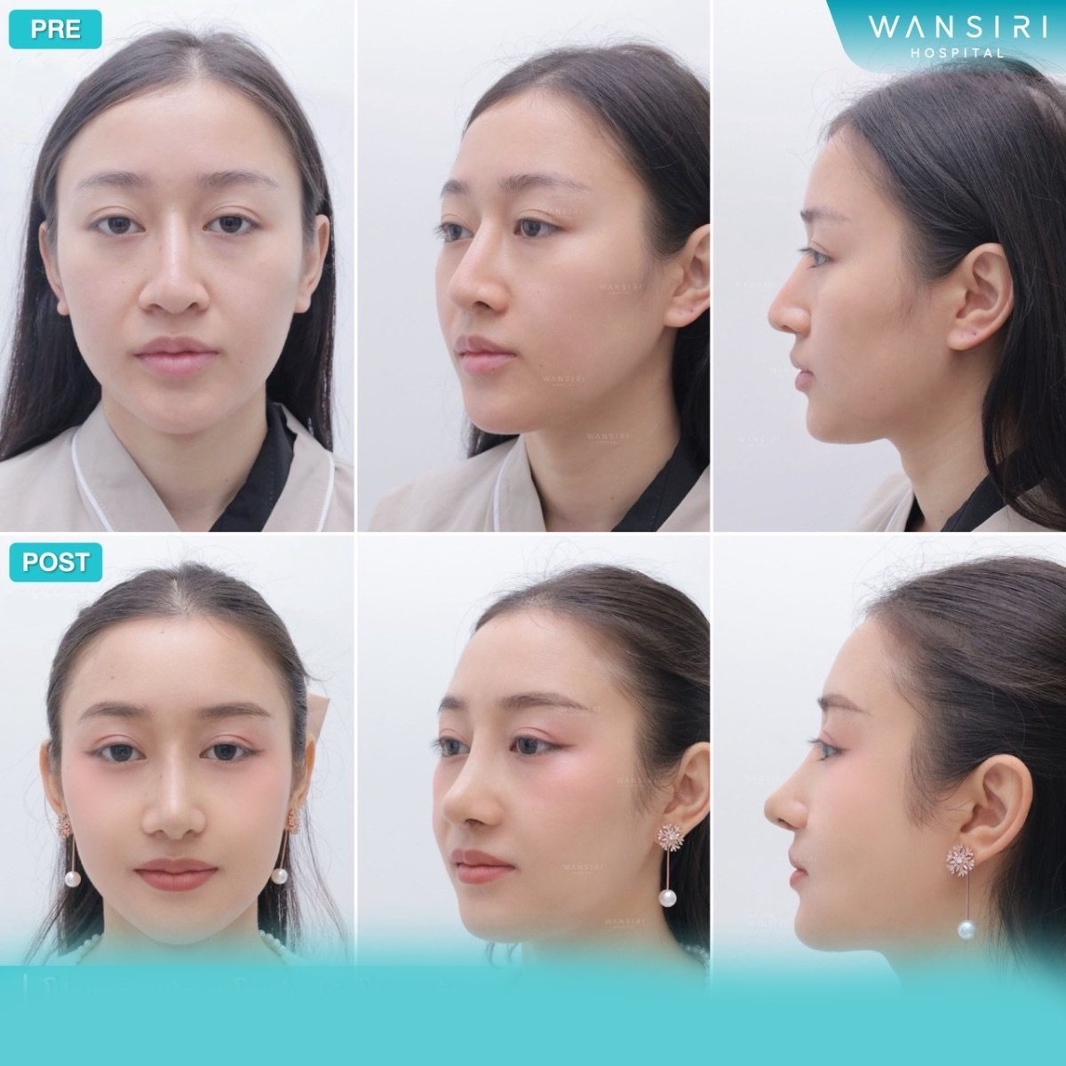 Before and after septoplasty results at Wansiri Hospital, improved nose symmetry and profile