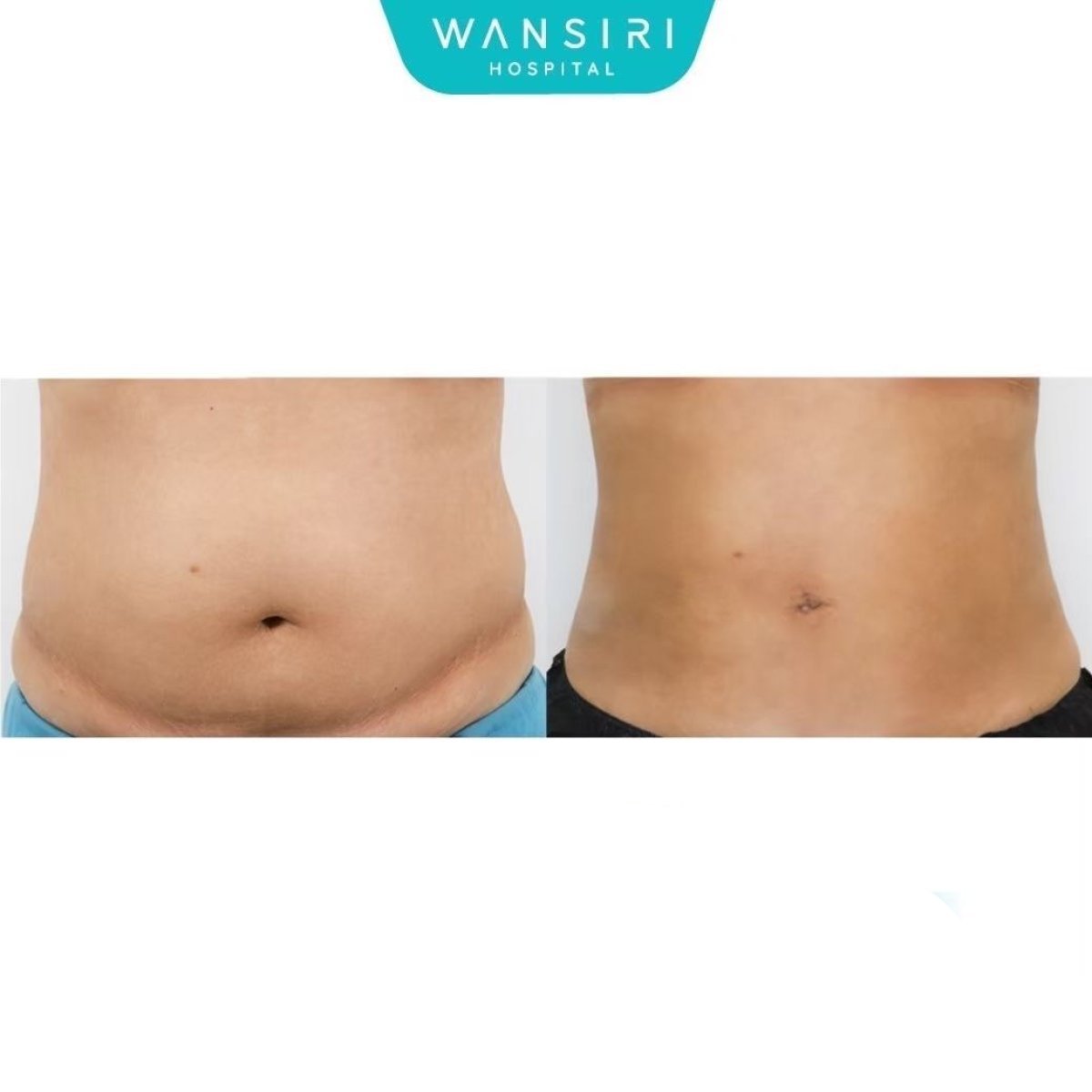 Résultat avant-après liposuccion poignées d'amour à Wansiri Hospital, taille affinée