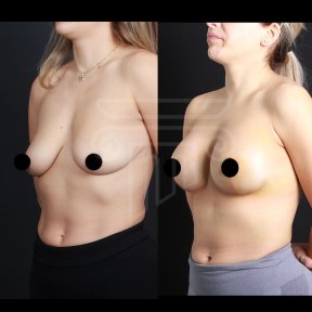 Premium Mommy Makeover Surgery-All Incluisive with European Board Certified Doctor Ali Sadioglu - photo 4