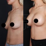 Before and after Вазер (Vaser) липосакция photos by Dr. Ali Sadioglu Md