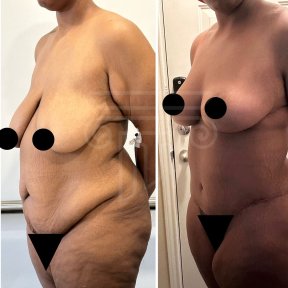 Premium Mommy Makeover Surgery-All Incluisive with European Board Certified Doctor Ali Sadioglu