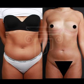 360 LIPOSUCTION -All ıncluisive with European Board Certified Doctor Ali Sadioglu