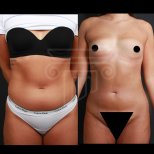 Fotos vor und nach Fettabsaugung am Bauch durch Dr. Ali Sadioglu Md