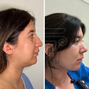 ALL INCLUİSİVE NECK LIFT WITH LIPO - photo 3