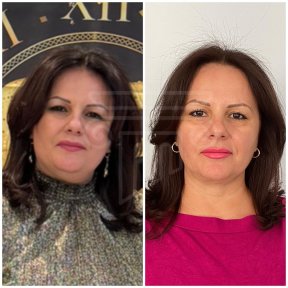 ALL INCLUİSİVE NECK LIFT WITH LIPO