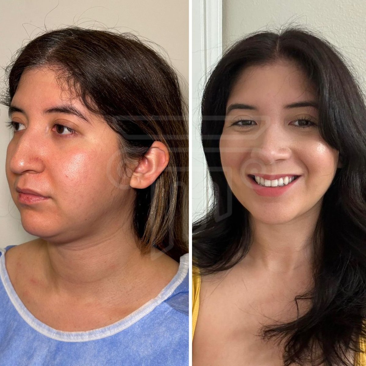 Before and after chin liposuction results at Dr. Safa Manav Clinic, defined jawline improvement