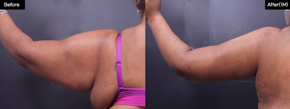 Результати ліпосакції рук до і після у VG Plastic Surgery – стрункіший контур руки