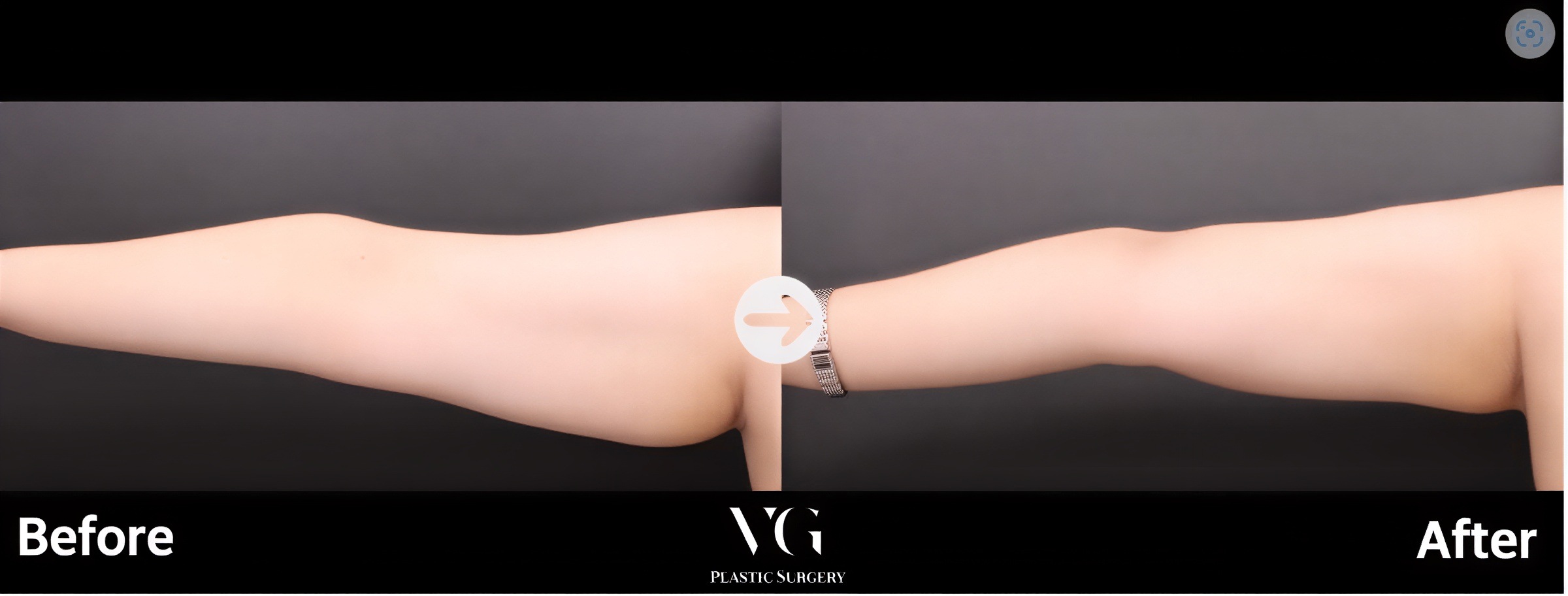 نتائج شفط دهون الذراع العلوية قبل وبعد في VG Plastic Surgery، ذراع أنحف