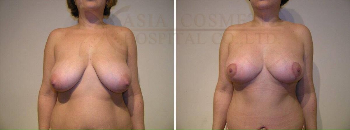 Before and after mommy makeover results at Asia Cosmetic Hospital, breast lift and contouring