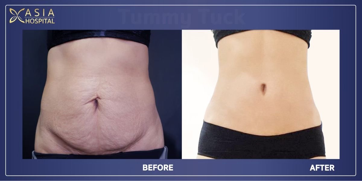 Before and after tummy tuck results at Asia Cosmetic Hospital – flatter, firmer abdomen