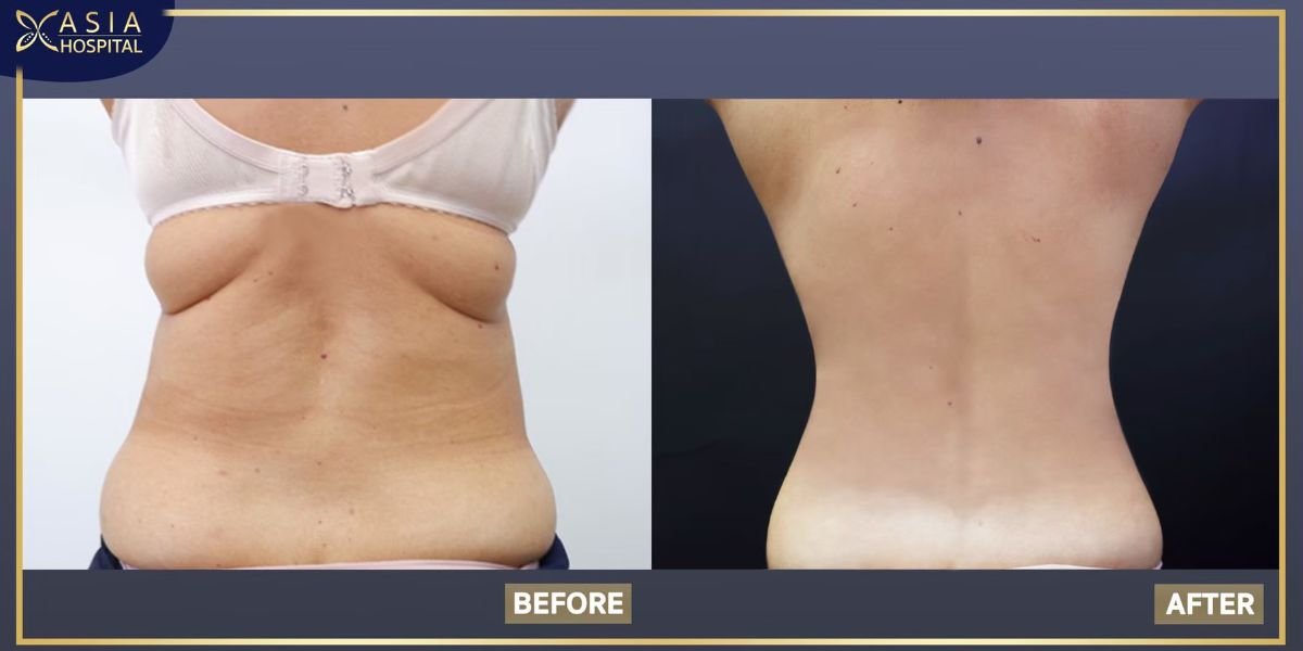 Mommy makeover before and after results at Asia Cosmetic Hospital – visible body contouring