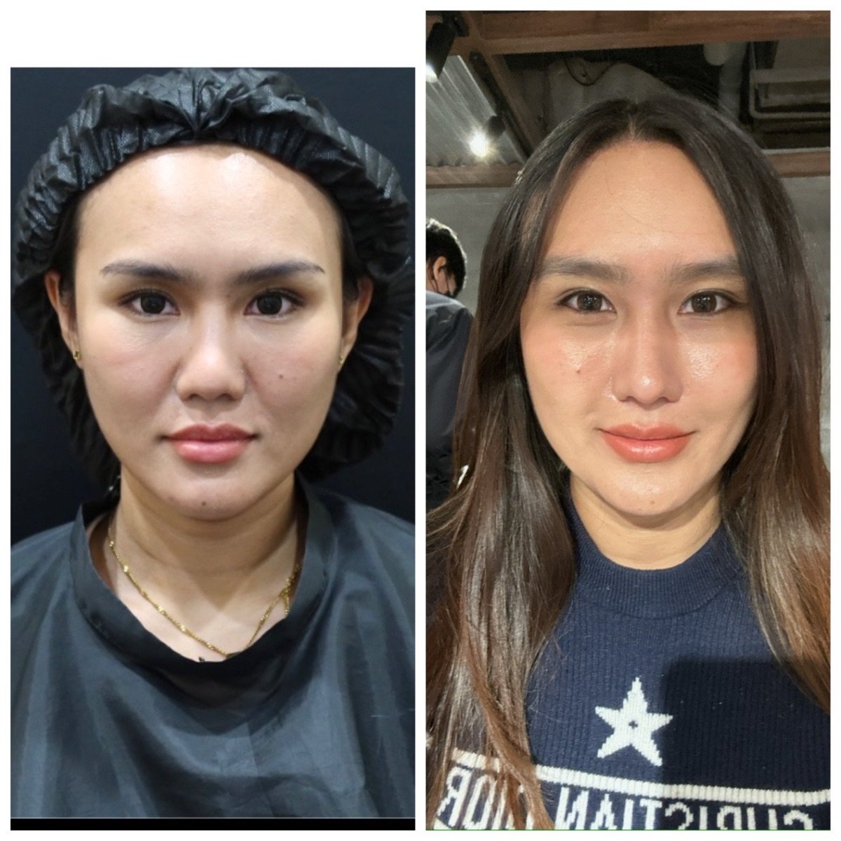 Before and after stem cell therapy facial rejuvenation results at Wansiri Hospital