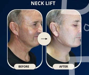 Facelift lift All Inclusive Premium Package - photo 4