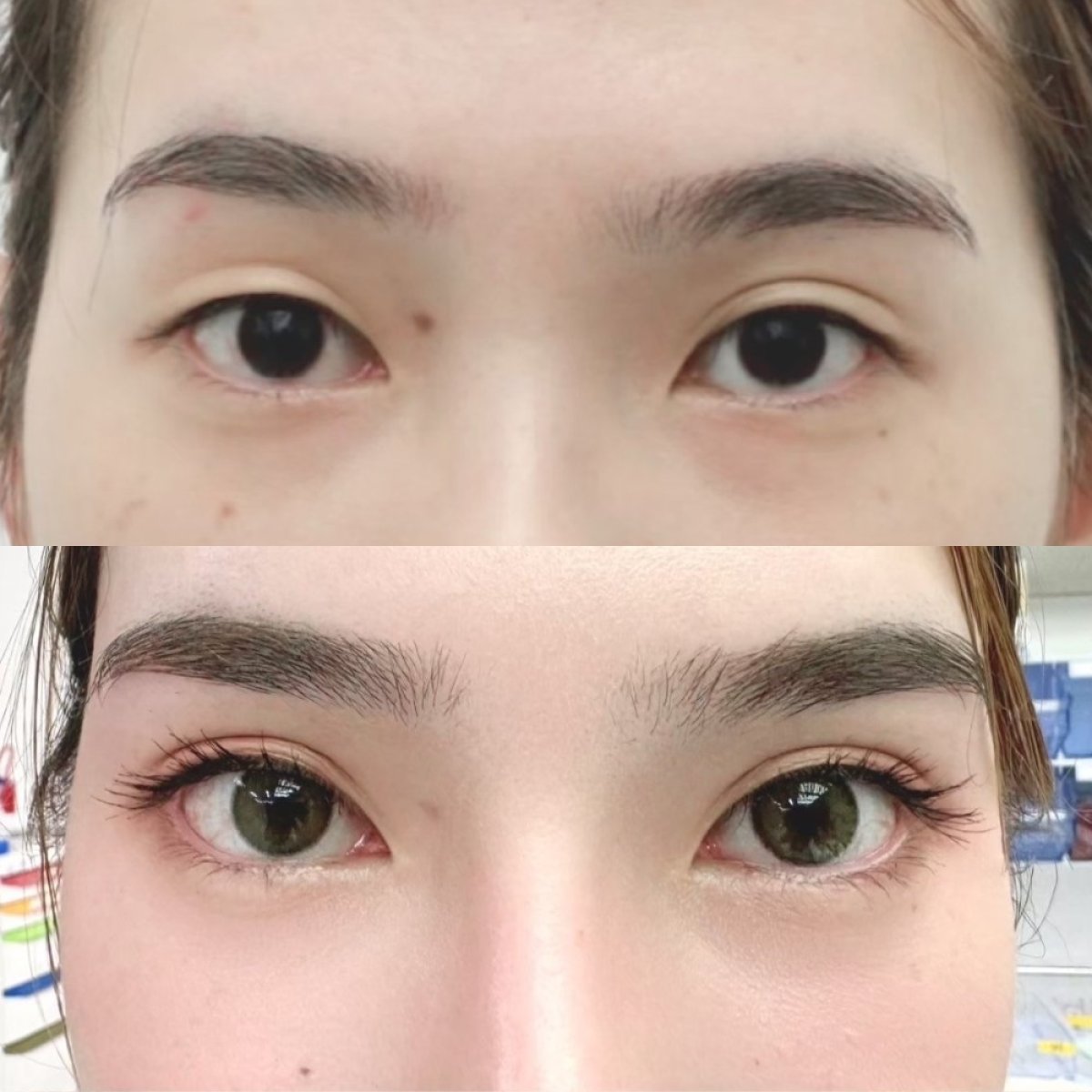 نتائج قبل وبعد Fox Eye Lift في مستشفى Wansiri، تحسين شكل ورفع العين