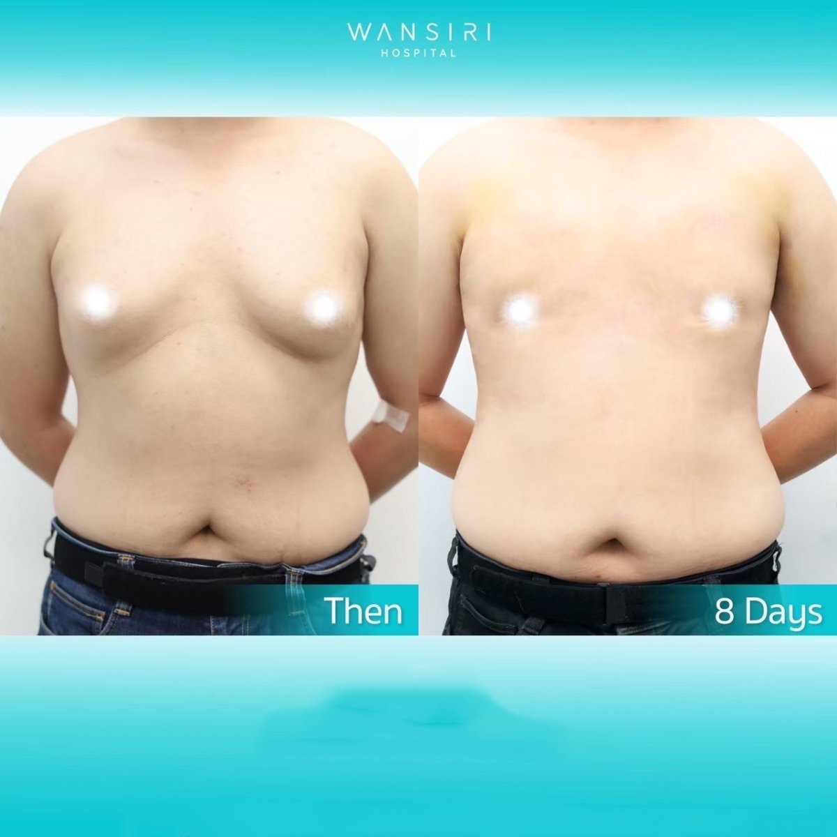 Avant/après liposuccion pour gynécomastie à Wansiri Hospital, résultat du contour thoracique