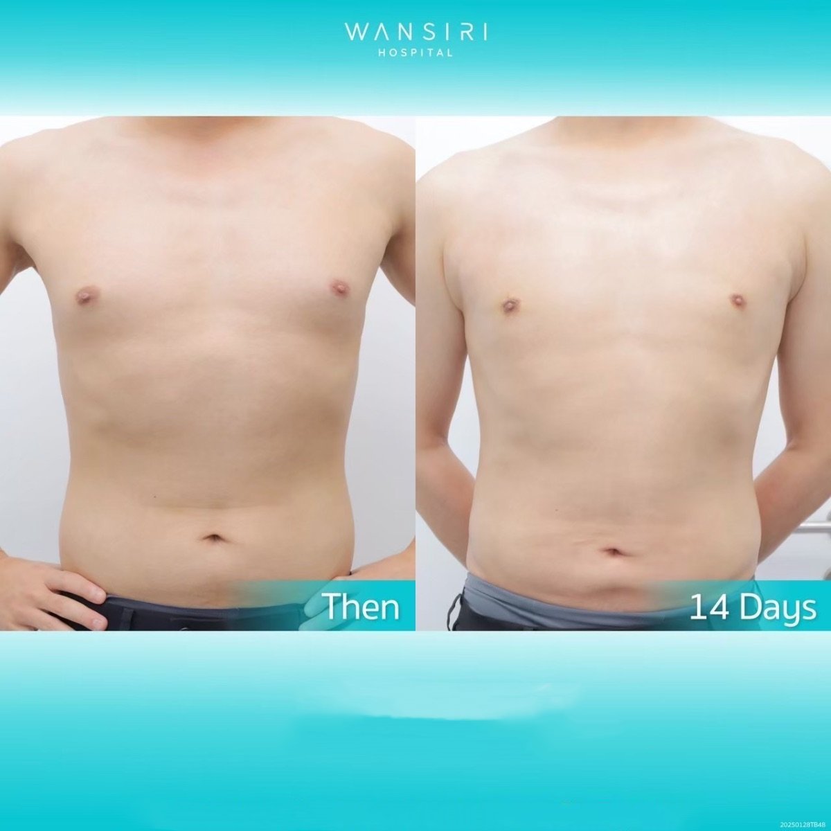 Avant/après liposuccion pour gynécomastie à Wansiri Hospital, résultat du contour thoracique