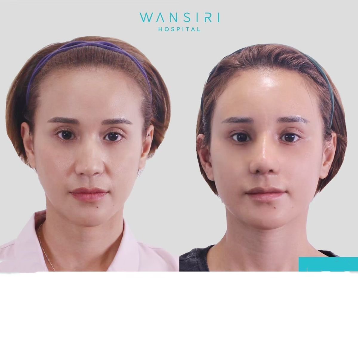Результаты подтяжки бровей до и после в Wansiri Hospital, видимый лифтинг лба и бровей