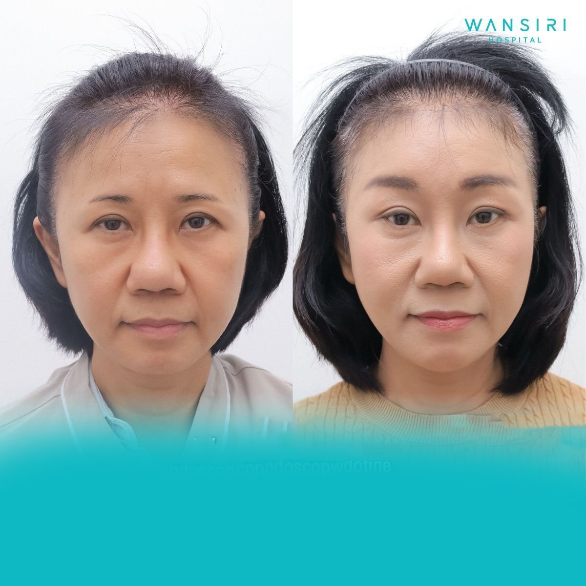 Before and after brow lift results at Wansiri Hospital, visible forehead and eye area rejuvenation
