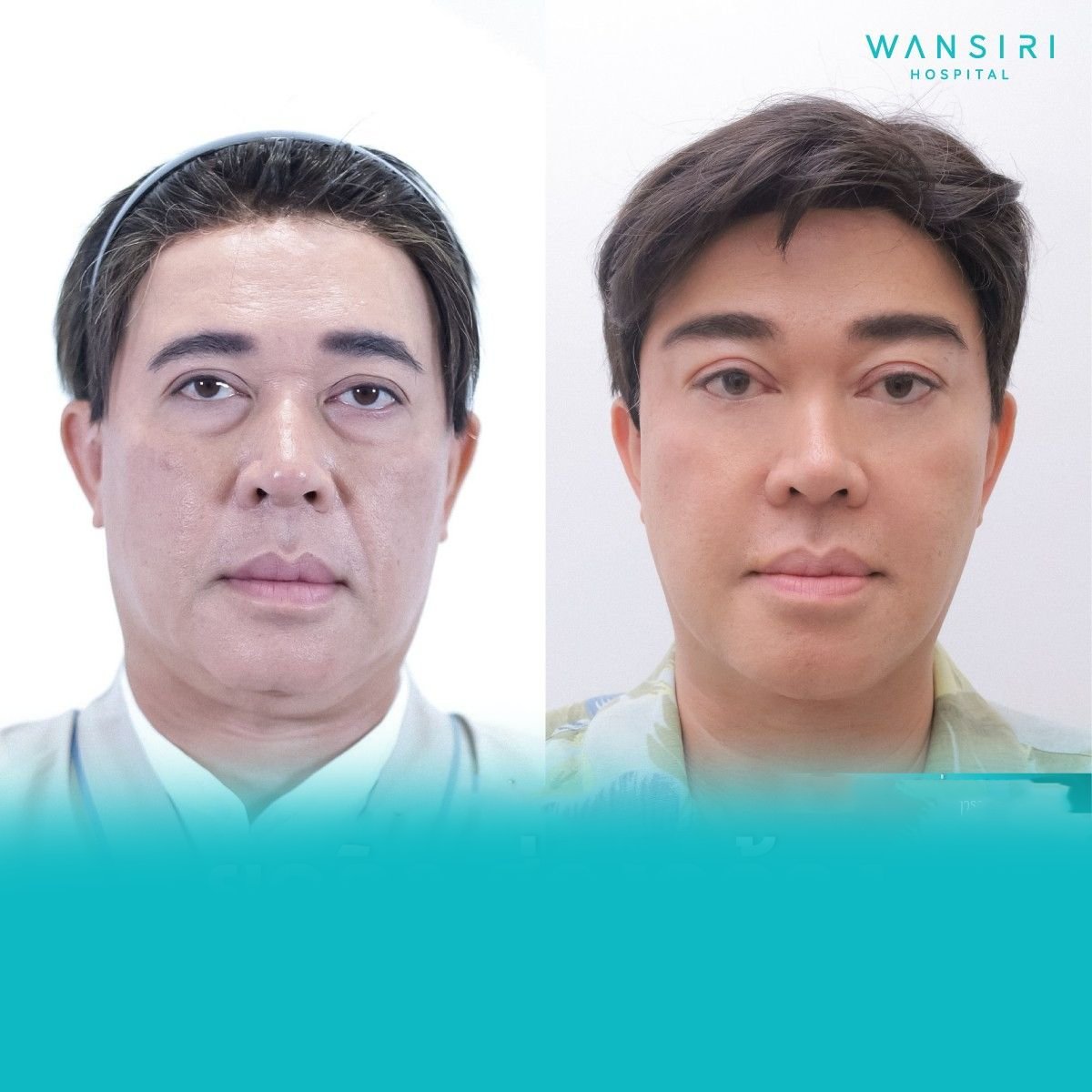Resultados de lifting de cejas antes y después en Wansiri Hospital, mejora visible de frente y ojos