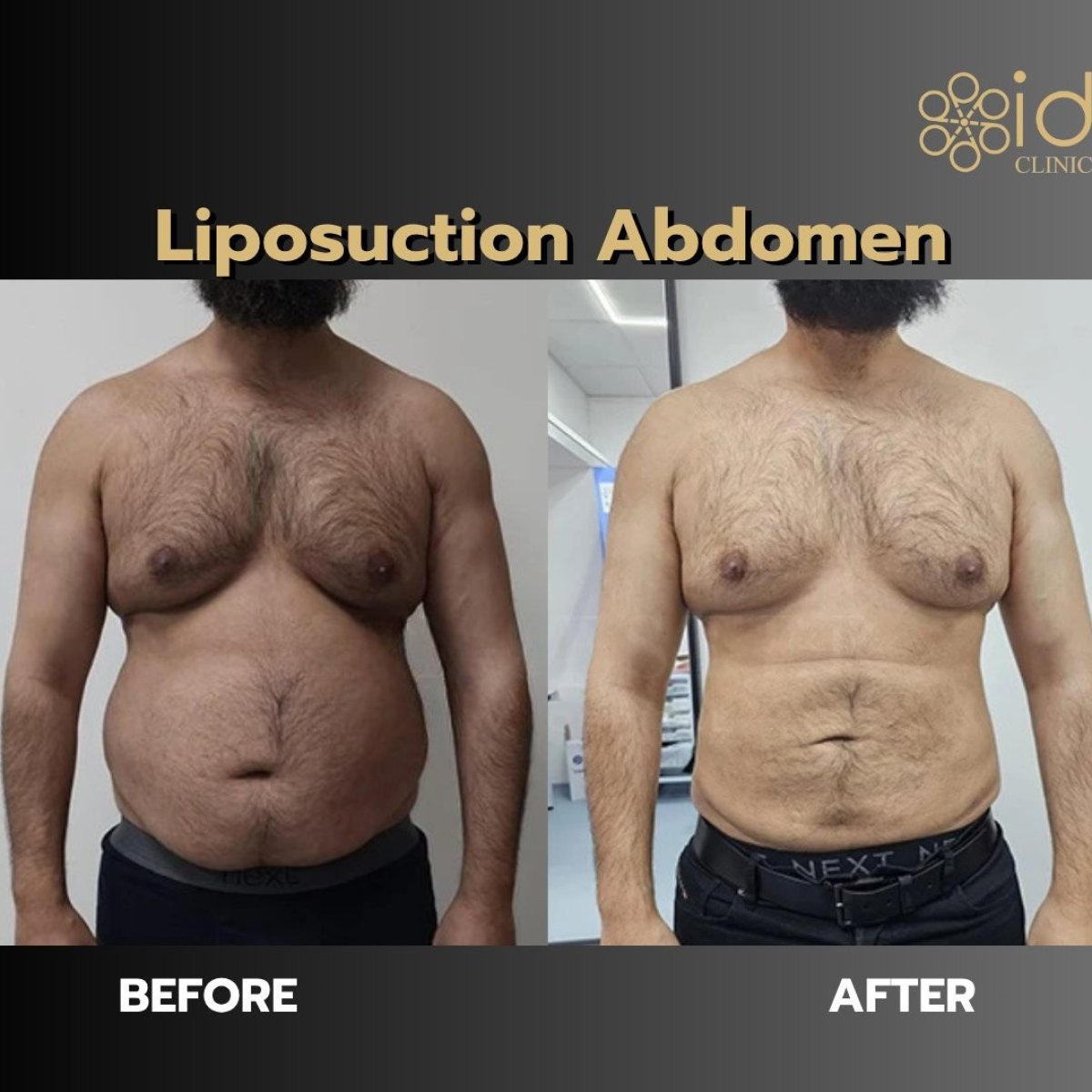 Resultados de liposucción abdominal antes y después en ID Clinic Bangkok, contorno visible