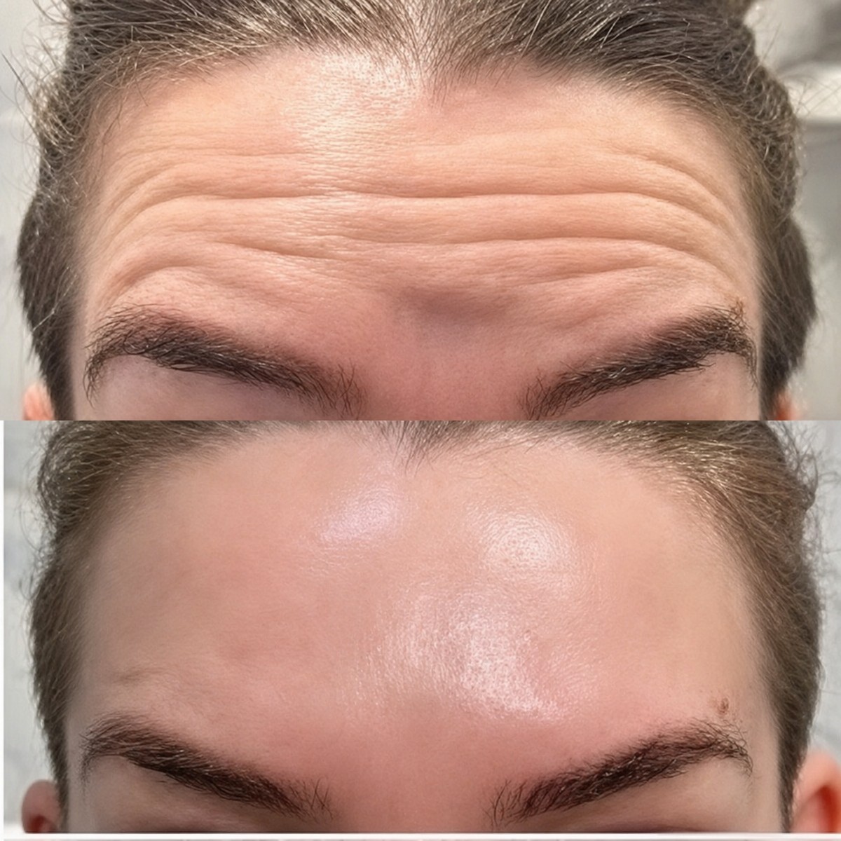Antes y después de inyecciones de bótox en Adem and Havva Medical Center, resultado reducción arrugas frente