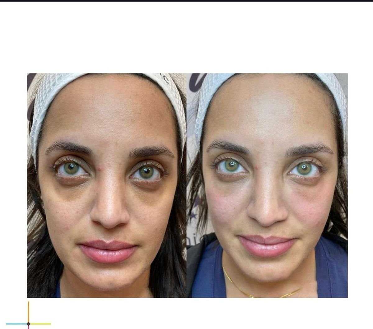 Antes y después de inyecciones de bótox en Adem and Havva Medical Center, menos bolsas bajo los ojos