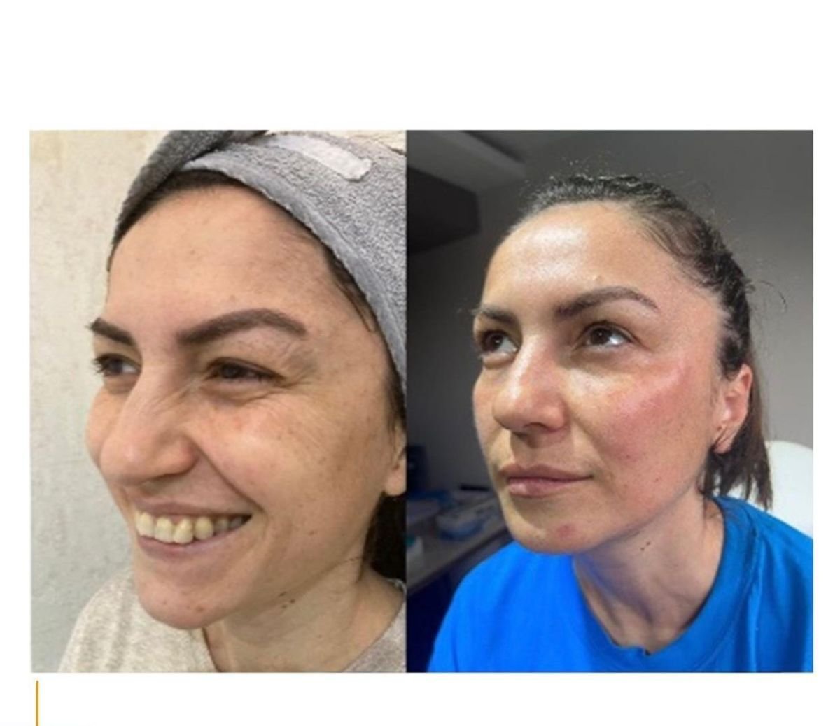 Antes y después de inyecciones de bótox en Adem and Havva Medical Center, menos arrugas faciales