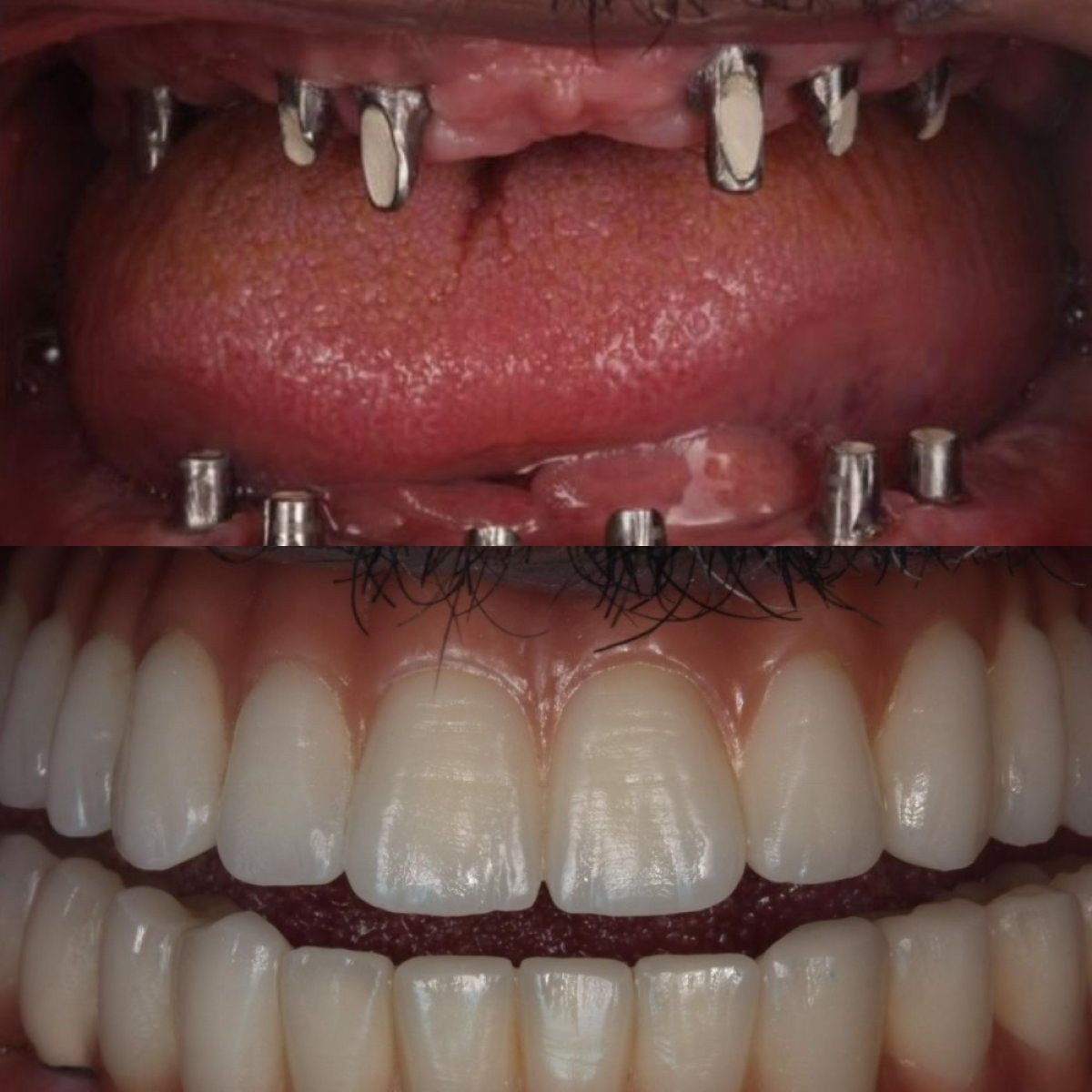 Результат до и после имплантации All-on-6 в DENTAGLOBAL Dental Clinic, восстановление улыбки