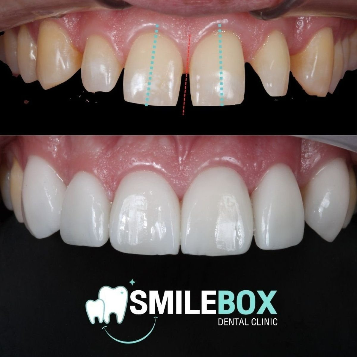 Résultats avant et après prothèse dentaire chez SmileBox Dental Clinic - Thonglor, Sukhumvit Branch