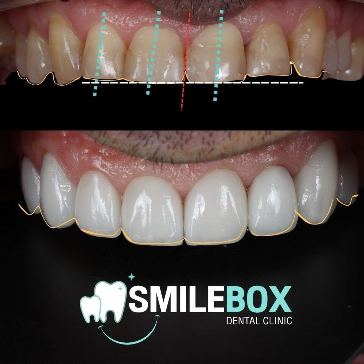 Résultat avant et après facettes dentaires à SmileBox Dental Clinic - Thonglor, Sukhumvit Branch