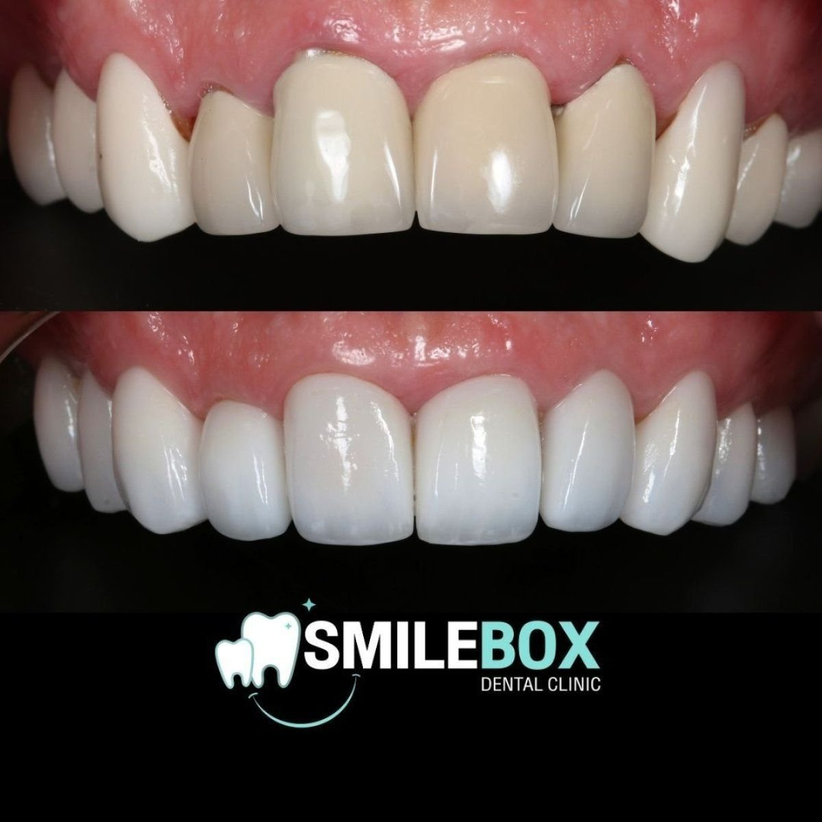 Resultados de dentadura antes y después en SmileBox Dental Clinic - Thonglor, Sukhumvit Branch