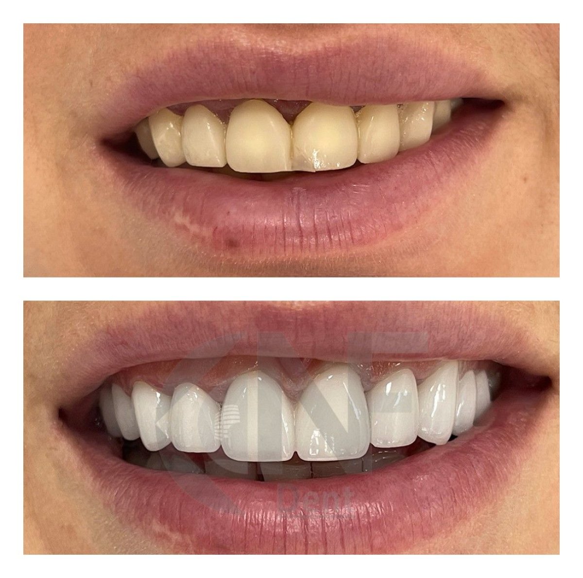 Before and after veneers at Nifa Dent International – smile makeover with whiter teeth result