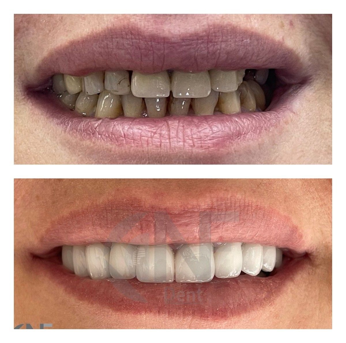 Before and after veneers at Nifa Dent International, smile transformation with natural results