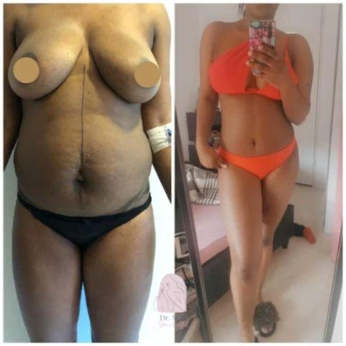 Resultado de liposucción (5 áreas) antes y después en Dr. MED – contorno corporal visible