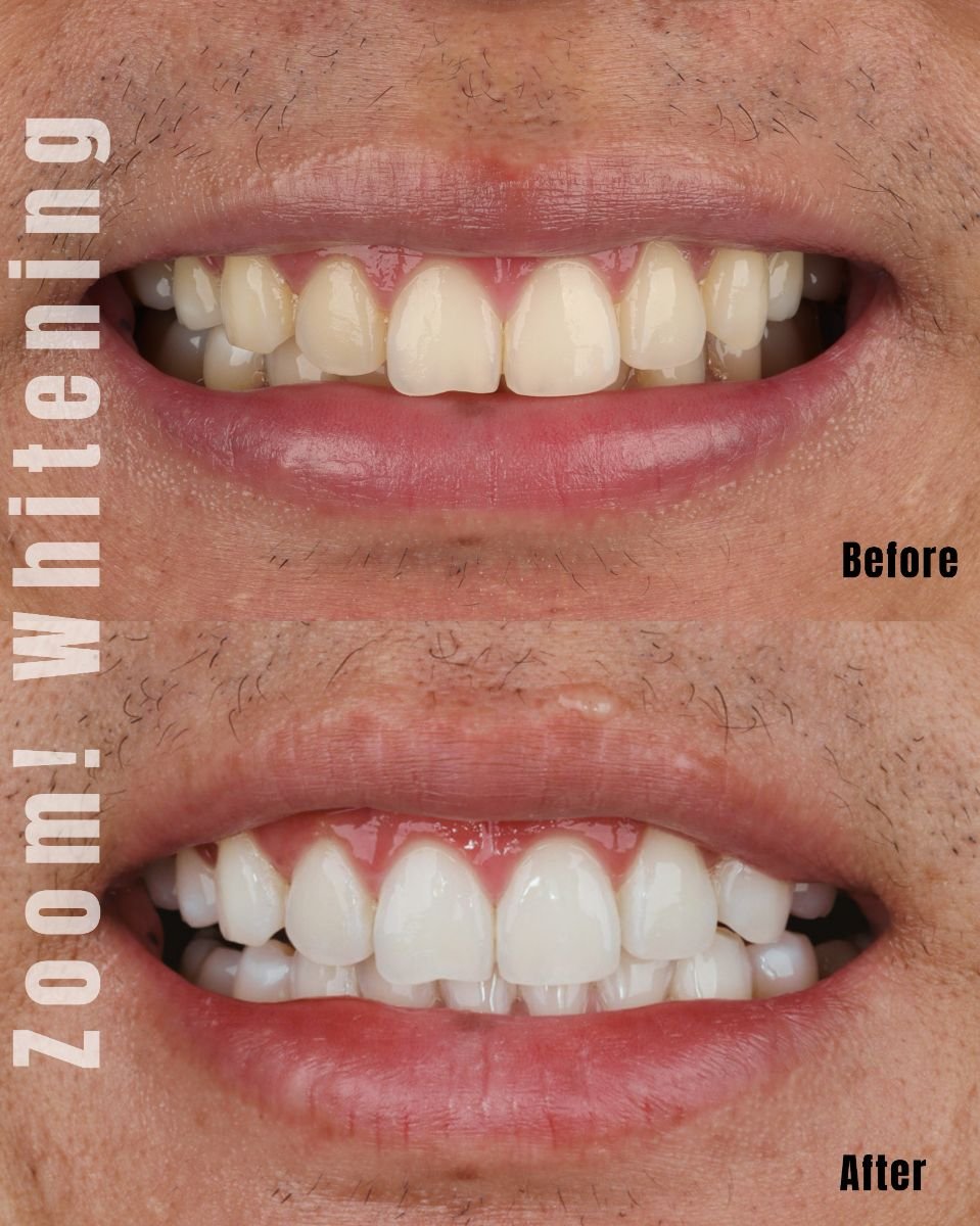 Before and after tooth whitening results at SmileBox Dental Clinic - Thonglor, Sukhumvit Branch