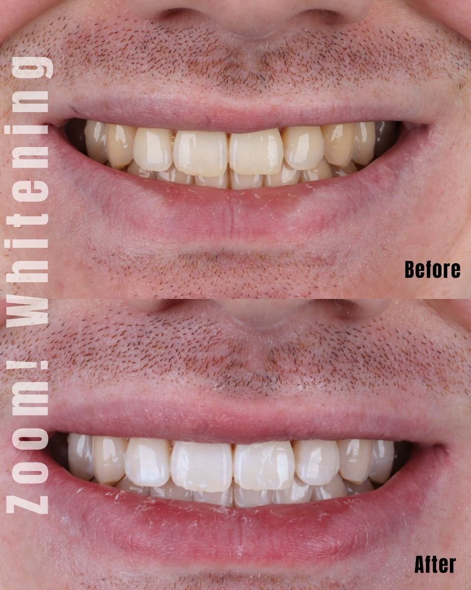 Résultats avant et après blanchiment dentaire à SmileBox Dental Clinic - Thonglor, Sukhumvit Branch