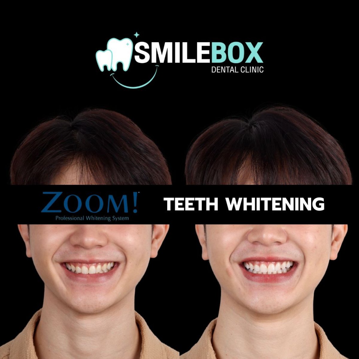 Résultats avant et après blanchiment des dents à SmileBox Dental Clinic - Thonglor, Sukhumvit Branch