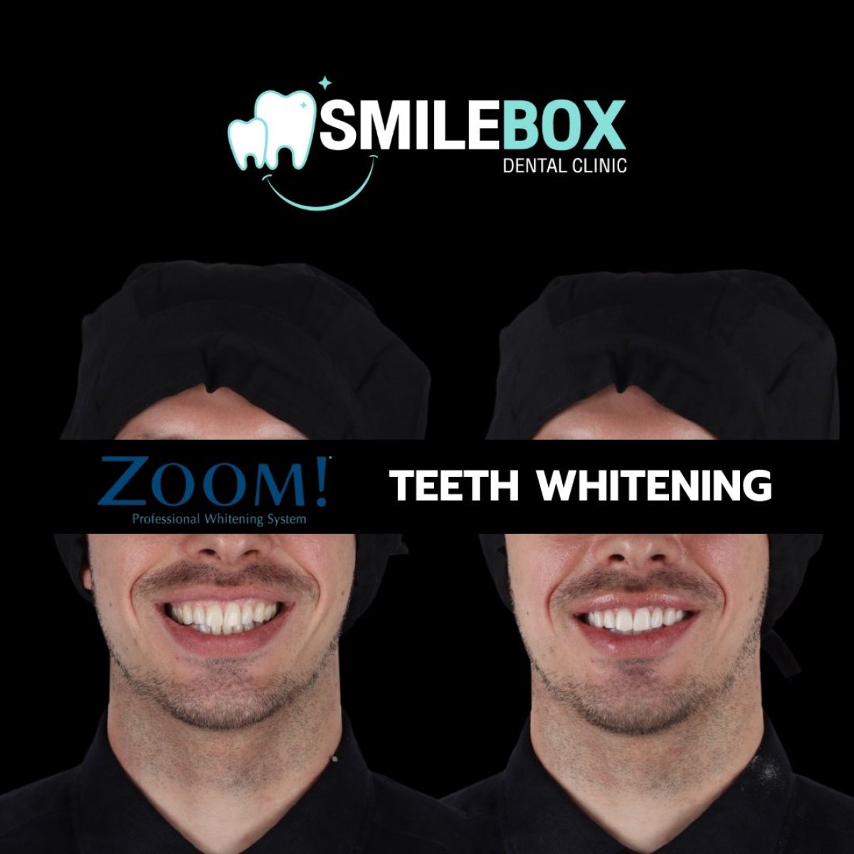Resultados antes y después del blanqueamiento dental en SmileBox Dental Clinic - Thonglor, Sukhumvit Branch
