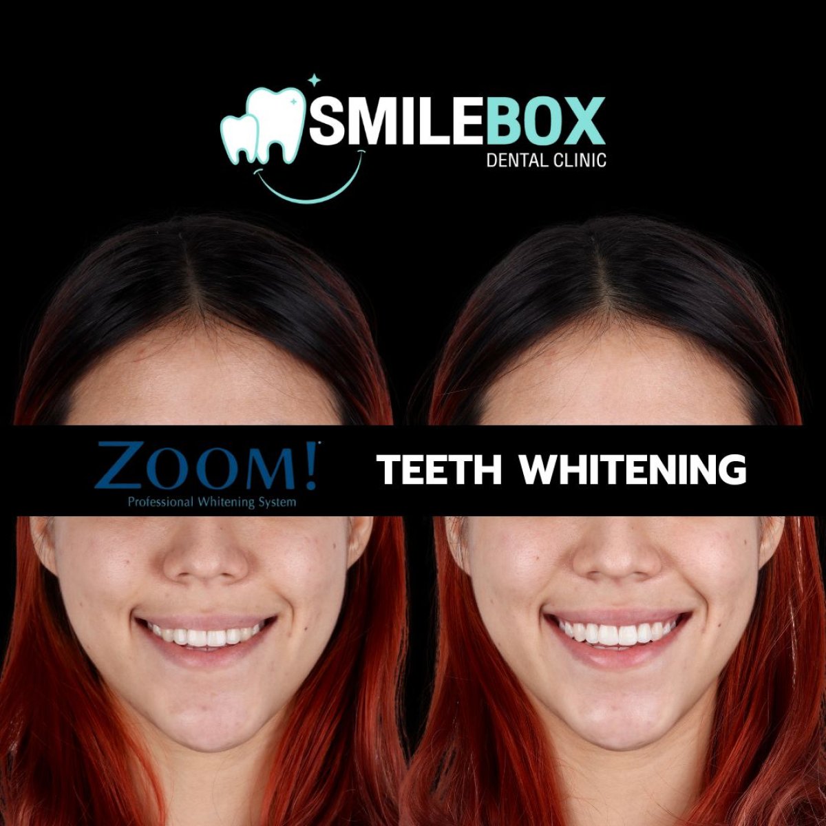 نتائج تبييض الأسنان قبل وبعد في SmileBox Dental Clinic - Thonglor, Sukhumvit Branch
