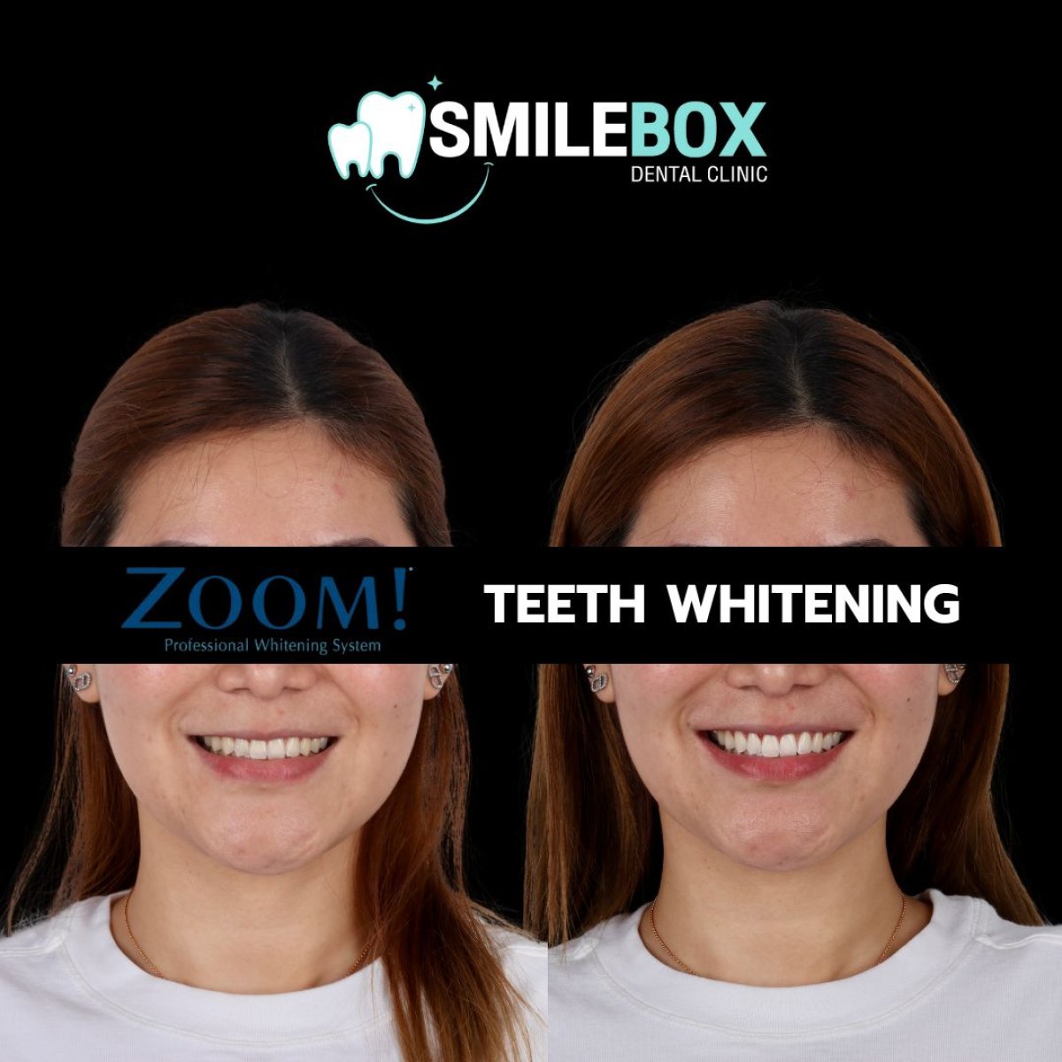 Результати до і після відбілювання зубів у SmileBox Dental Clinic - Thonglor, Sukhumvit Branch