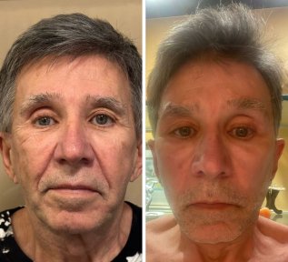 Premium Face&Neck lift + Upper Blephasroplasty+ Fat Transfer to Face Surgery -All Incluisive with European Board Certified Doctor Ali Sadioglu - photo 2